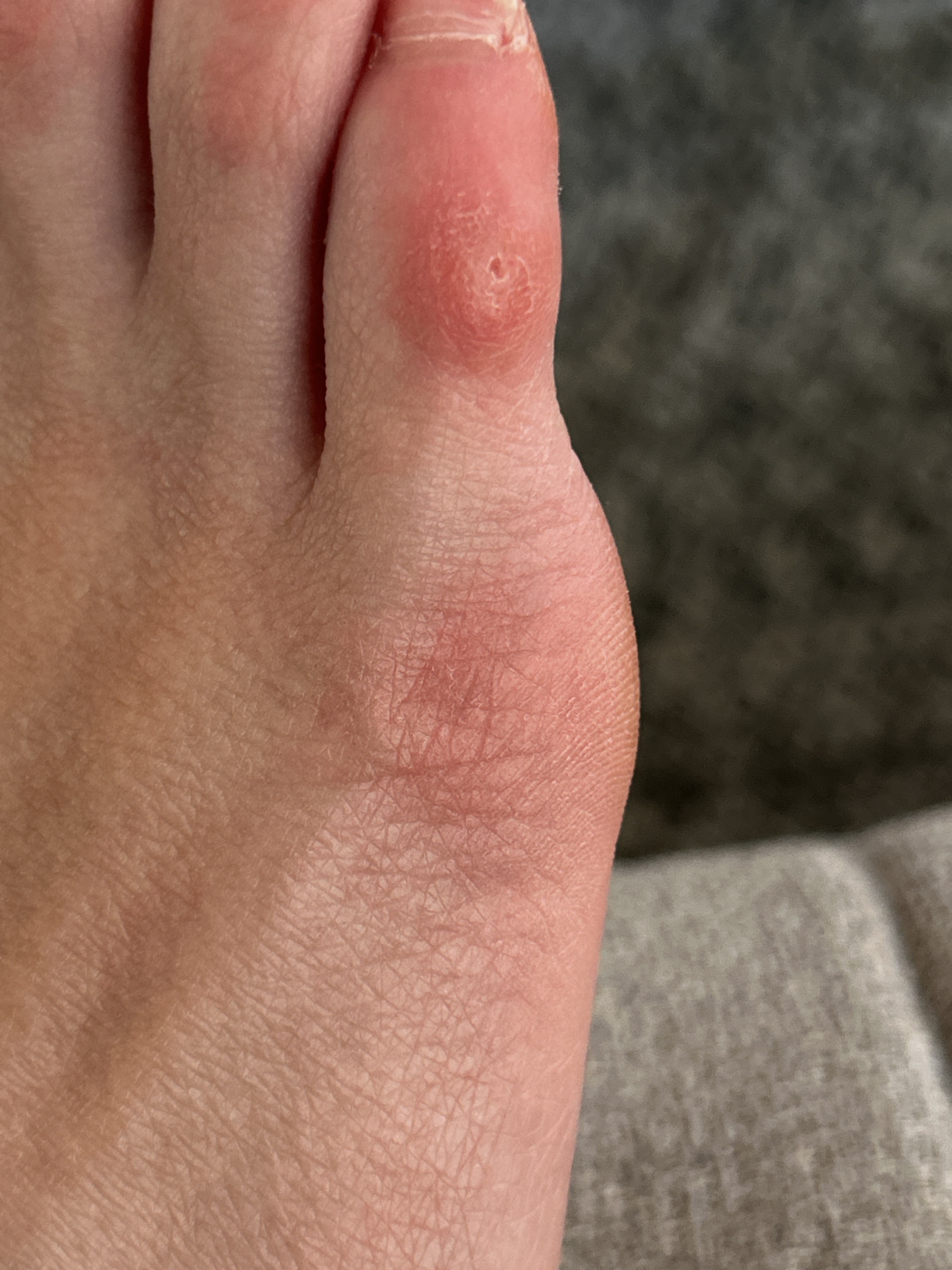 Bruised toes from cowboy boots